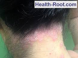 A psoríase no couro cabeludo, também chamada de psoríase capilar, e a dermatite seborreica integram o mesmo conjunto de problemas cutâneos. Psoriase Do Couro Cabeludo Doenca Sintomas Tratamento 2021