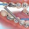 During this period, you may feel like the brackets are poking into your gums to help you manage the pain and learn how to eat with your new braces, here is our expert advice. 1