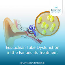Image result for Eustachian Tube Dysfunction