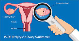 (estrogen is stored in fat, so the less we have, the lower our risk of being estrogen dominant) 17 Home Remedies To Treat Pcos Prevention Tips