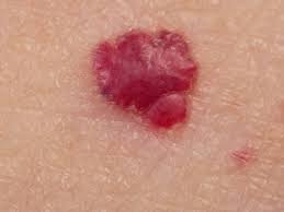 Cherry angioma, also called cappilary angioma, cherry hemangioma, cherry haemangioma cherry angioma laser removal is considered to be a safe treatment. Treatment For Cherry Angiomas Lasermed Laser Hair Removal Laser Tattoo Removal Laser Clinic Cape Town Skin Rejuvenation Fractional Resurfacing Laser Chemical Peels