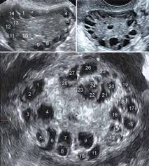 It is characterized by irregular menstrual periods, excess male hormones, and/or ovarian cysts. Transvaginal 2d Scan Using A 7 5 Mhz Probe In A Pcos Patient Antral Download Scientific Diagram