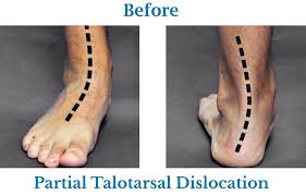 The soft tissue near the however, if having tried these non invasive techniques, the bony prominence remains tender. Flat Foot Correction Hyprocure Advanced Stent Procedures Feet For Life Podiatry Foot Doctor In St Louis And Chesterfield Mo