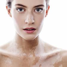 Introduction, epidemiology, quality of life, diagnosis, differential lu t., gao t., wang a., jin y., li q., li c. Vitiligo Symptome Ursachen Und Therapie Brigitte De