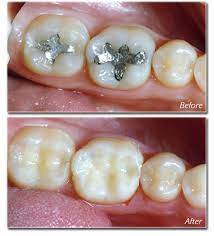 Getting Your Metal Fillings Replaced Is Very Important Metal Fillings Are A Source Of Immune Problems In Almost Eve Amalgam Fillings Dentistry Dental Fillings