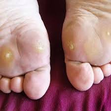 Warts are the cutaneous manifestations of human papilloma virus (hpv) that may exist in different the use of oral acitretin in the treatment of recalcitrant warts is under studied in literature where. Symptoms Causes And Treatment For Plantar Warts