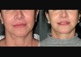 Andrew Jacono, MD-The New York Center for Facial Plastic and Laser  Surgery...