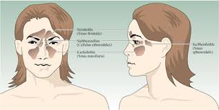 Die entzündung der nasennebenhöhlen nennt der fachmann sinusitis. Nasennebenhohlen