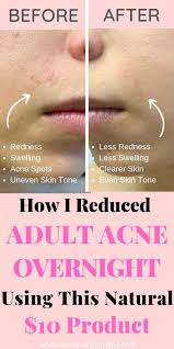 Use it sparingly as a spot treatment for acne, says rabach. 11 Life Changing Benefits Of Thayer S Witch Hazel Toner Sincerely Farah Witch Hazel Toner Thayers Witch Hazel Jawline Acne