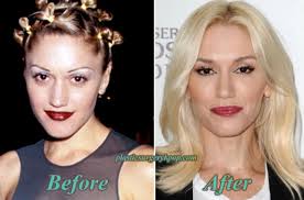 Gwen stefani botox and eyelid surgery. Gwen Stefani Plastic Surgery Before And After Pictures