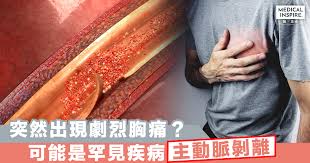 Include (or exclude) self posts. èªè­˜ç–¾ç—… çªç„¶å‡ºç¾åŠ‡çƒˆèƒ¸ç—› å¯èƒ½æ˜¯ç½•è¦‹çš„åš´é‡è‡´å'½ç–¾ç—… ä¸»å‹•è„ˆå‰é›¢ Medical Inspire é†« æ€ç¶­