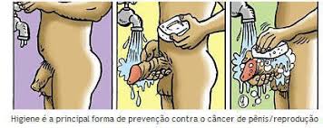 Resultado de imagem para CANCER DE PENIS