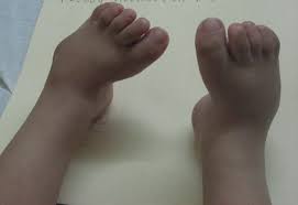 Image result for Clubfoot