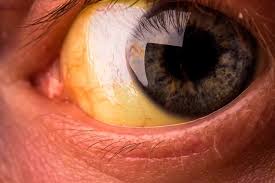 Simplified criteria for the diagnosis ≥7 баллов: Gelbe Augen Ursachen Und Behandlung Area Oftalmologica Avanzada