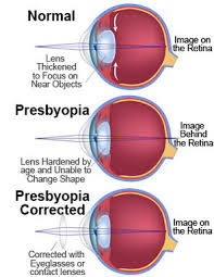 Image result for Refractive Error