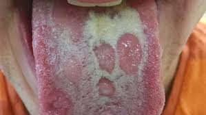 Image result for syphilis ulcer