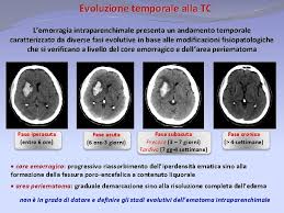Altre cause responsabili di emorragia cerebrale sono emorragie subdurali. Ictus Emorragico Intraparenchimale Un Update Impiego Appropriato E