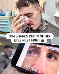But his eyes look good compare to how he described the pains haha 😄 Tom  Aspinall is just a joke 😃 #followersreelsfypシ゚viralシfypシ゚viralシalシ #UFC321  #ufcnews