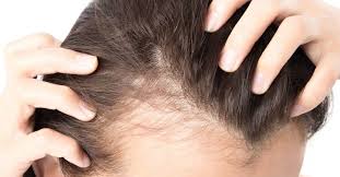 Haircuts to hide a receding hairline , there are many hairstyles for women that can support thin locks. Female Pattern Baldness Causes Treatment And Prevention