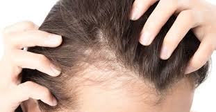 Men who go bald naturally tend to retain some hair over their ears and around the back of the head, so they needed a wig even for the bald look. Female Pattern Baldness Causes Treatment And Prevention