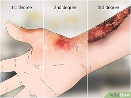 Also, as the burn heals it will itch. How To Heal Burns Fast With Pictures Wikihow