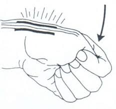 The wrist is then bent in the direction of the little finger. Tendovaginitis Stenosans De Quervain Handchirurgie Bochud Ag Praxis Dr Med Rene Ch Bochud