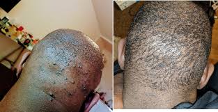 The disorder is caused by damage to the follicles, by a blocked follicle, by shaving, or by friction caused by clothing, helmet straps, and the like. Folliculitis Scalp Hair Loss