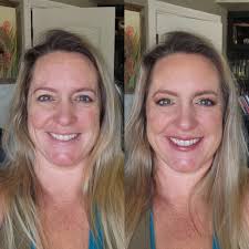 One week down. I've had quite a bit of swelling and bruising, but couldn't  be happier with the outcome.. Surgery