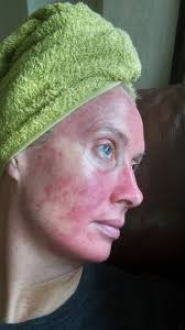 Day 10 healing All good except for I'm the colour of a pig 🐷 Going to  venture out tomorrow in daylight 😕 I'm more anxious about that than going 