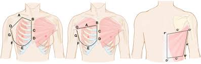 Poland syndrome is characterized by an underdeveloped or absent chest muscle on one side of the body, absence of the breastbone portion. Breast Reconstruction In Poland Syndrome Patients With Latissimus Dorsi Myo Flap And Implant An Efficient Endoscopic Approach Using Single Transverse Axillary Incision Springerlink