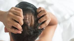 Pin On Maxim Hair Restoration Blogs
