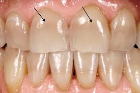 Med Bleaching Sanft Strahlend Schon Dr Hansen Munchen