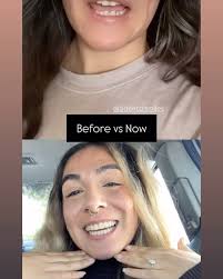 Every tray brings you closer to a confident, straighter smile—and we’re so  proud of the progress so far!, Invisalign makes the journey comfortable,  discreet, and totally life-changing., Stay tuned for ...