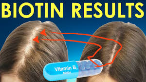 Biotin deficiency probably isn't the cause of your hair loss, but that doesn't mean it isn't a good idea to take a biotin supplement. Biotin Hair Growth Results Before And After Biotin Results For Hair Regrowth And Hair Loss Youtube