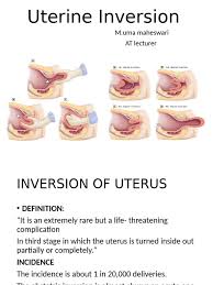 Image result for Uterine Inversion