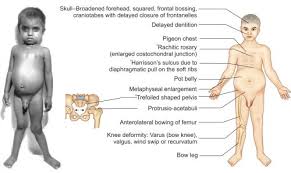 Image result for Craniotabes