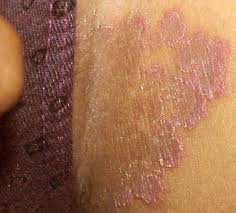 Inner Thigh Rash Inner Thigh Rash Dry Itchy Skin Remedies Skin Irritation Rash