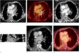 Malignant peritoneal mesothelioma (mpm) is a lethal cancer. Percutaneous Cryoablation For The Treatment Of Recurrent Malignant Pleural Mesothelioma Safety Early Term Efficacy And Predictors Of Local Recurrence Journal Of Vascular And Interventional Radiology