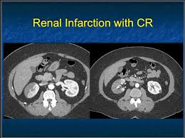 Image result for Renal Infarction