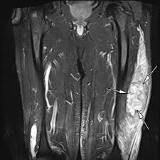 Common soft tissue injuries occur from a sprain, strain or soft tissue injuries. Soft Tissue Infections And Their Imaging Mimics From Cellulitis To Necrotizing Fasciitis Radiographics