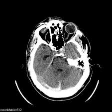 Cord Sign Radiology Reference Article Radiopaedia Org Radiology Brain Images Thrombosis