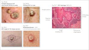 However, there is little literature evidence evaluating the efficacy and safety of this approach. Non Melanoma Skin Cancers Plastic Surgery Key