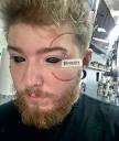 lunacobra | Healed black eye tattoos and face scar, going to LA ...