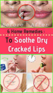 Here Are 6 Home Remedies To Soothe Dry Cracked Lips Mag For Health Cracked Dry Health Home Lips Mag Reme In 2020 Dry Cracked Lips Healing Dry Lips Cracked Lips
