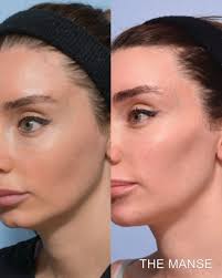 All told, each cheek should only take a few minutes. Cheek Fillers Before And After Sydney Dermal Filler Clinic