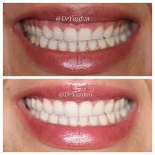 A dentist or a prosthodontist may initiate this procedure by gently sculpting the gum level with a diode laser. Results From Gingival Contouring To Correct A Gummy Smile Notice The Added Length In The Teeth Www Dryazdan Com Gummy Smile Correction Teeth Gummy Smile
