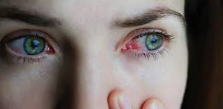 Image result for Allergic Conjunctivitis