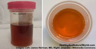 Dark Urine What Does It Mean Causes And Treatments Urinal Orange Pee Color Of Urine