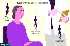 Pain and fractures, when cancer has spread to the bone headache, seizures, or dizziness, when cancer has spread to the brain shortness of breath, when cancer has spread to the lung Colon Cancer Recurrence Statistics