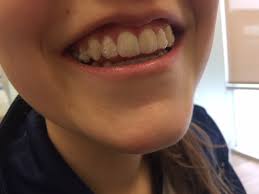 La technique Invisalign | Dre Isabelle Baillargeon Orthodontiste